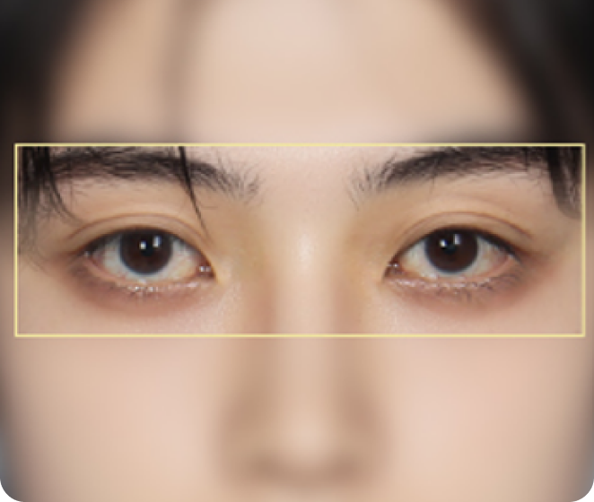 꺼진 눈/겹주름 쌍커풀