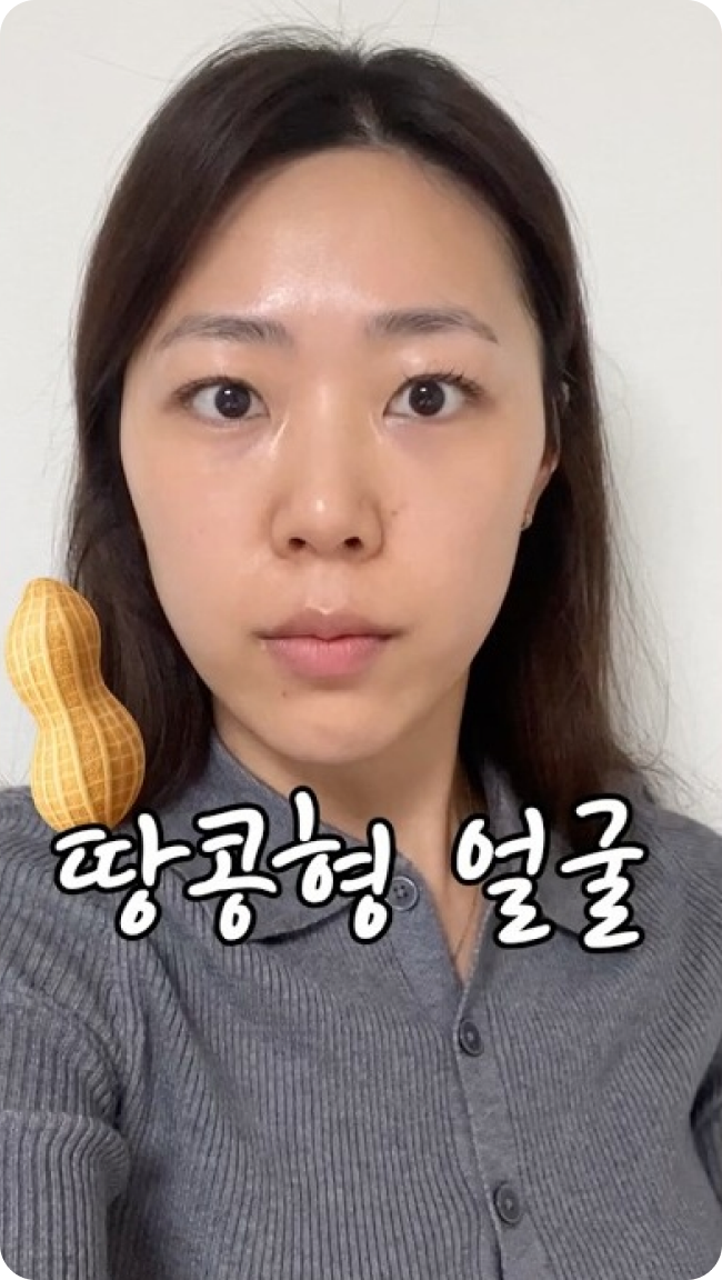 땅콩형 얼굴 개선